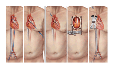 Transdermal Aortic Valve Repair Performed for the First Time at a Private Hospital in Limassol